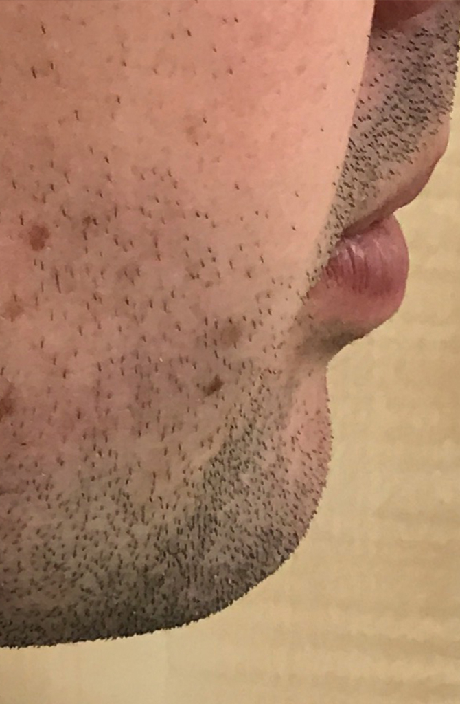 Chin Advancement — after (post-operative)